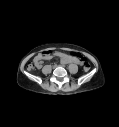 Fantoma de Abdómen/Pélvis